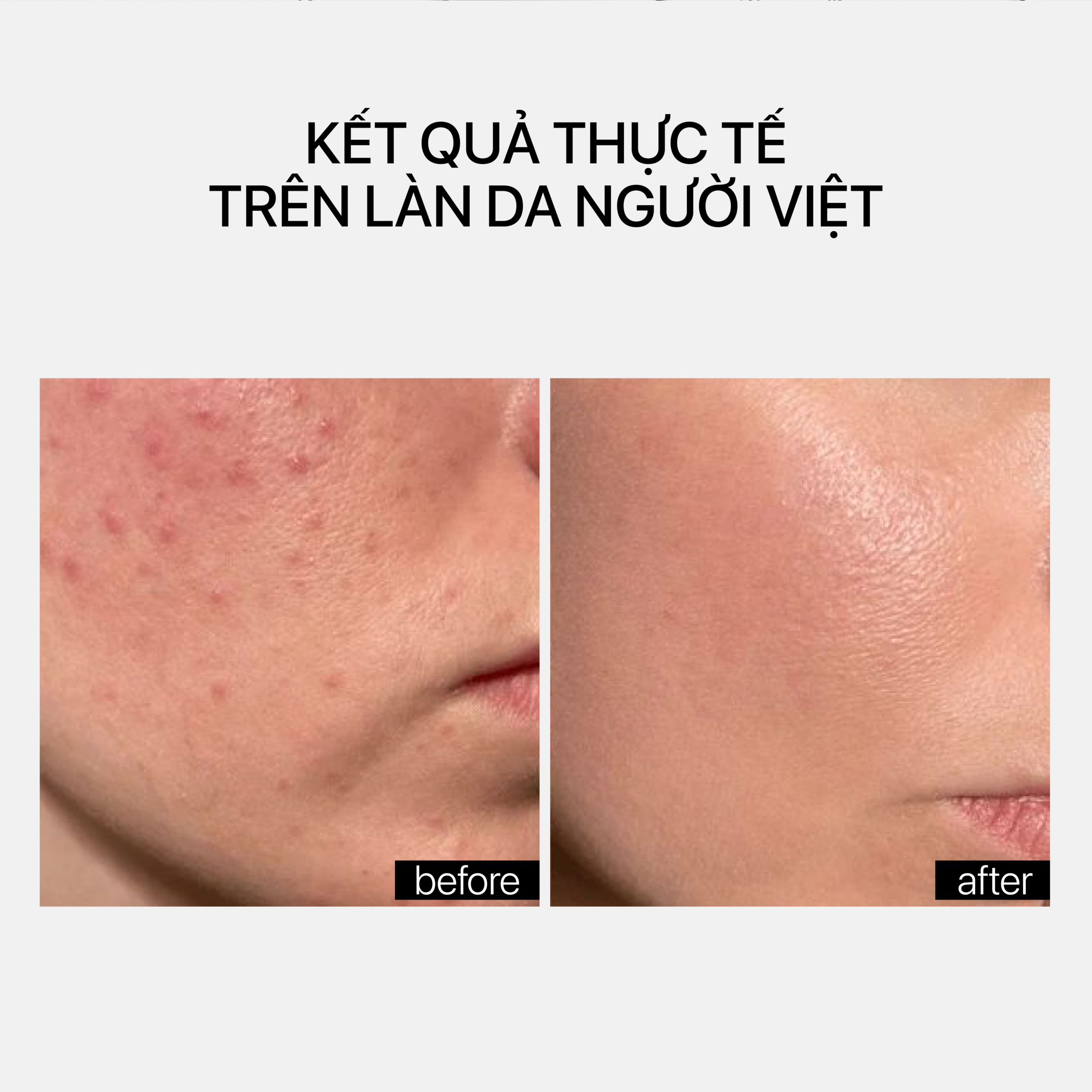 BLEMISH CONTROL BHA CLEANSER PH 3.5 - Ảnh 6