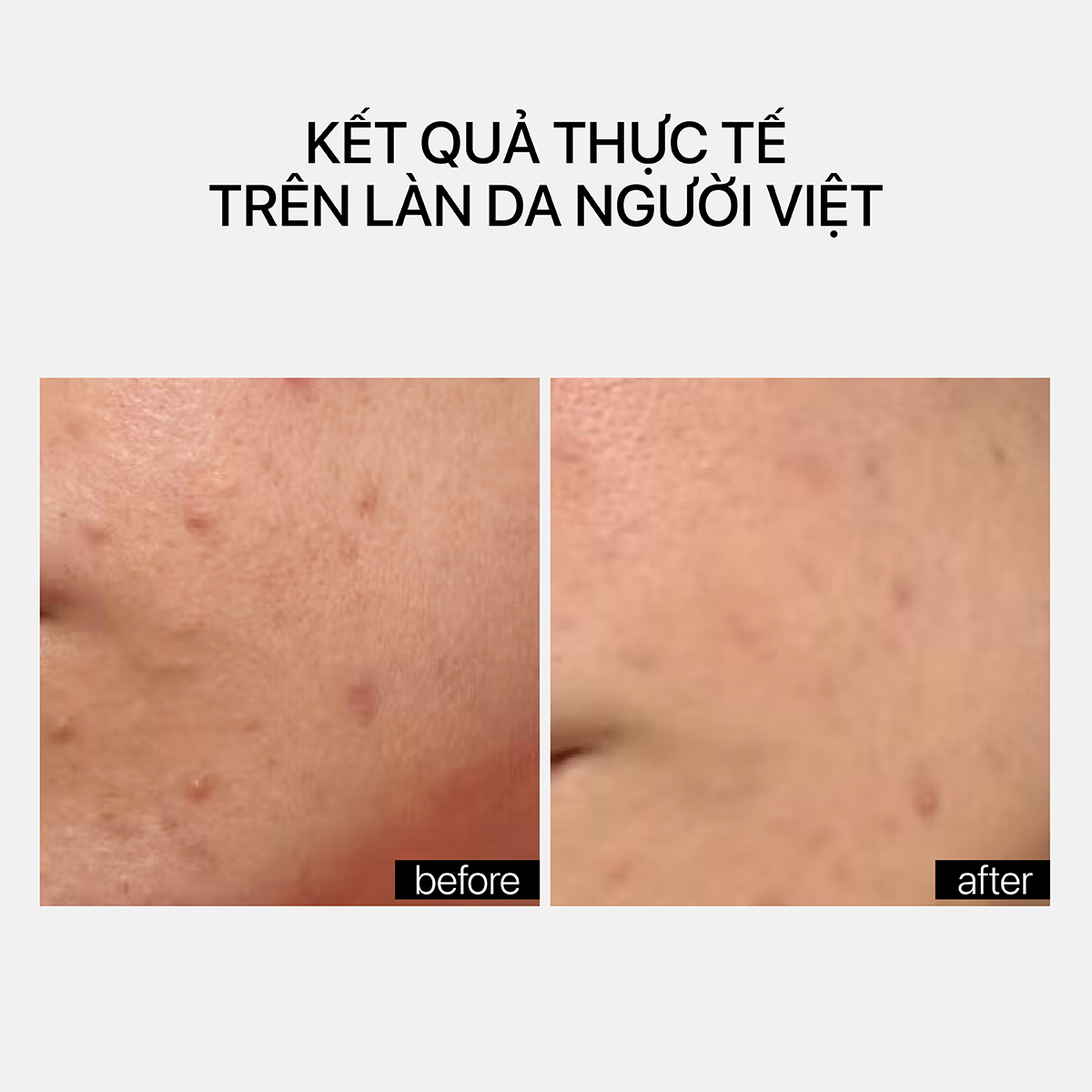 PIE ACNE RED SPOT FADING TREATMENT - Ảnh 4