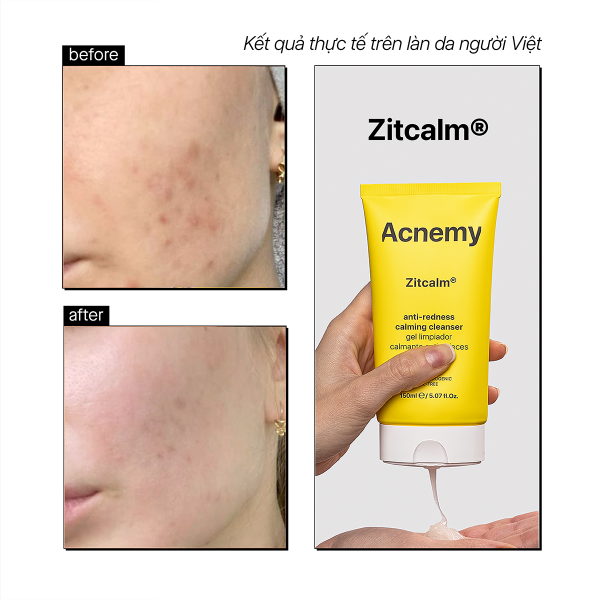 ZITCALM® ANTI REDNESS CALMING CLEANSER - Ảnh 5