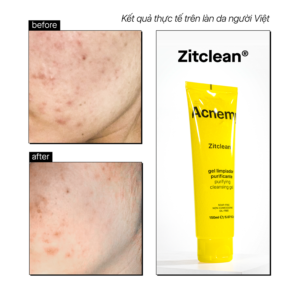 ZITCLEAN® PURIFYING CLEANSING GEL (Mini Size) 60ml - Ảnh 7