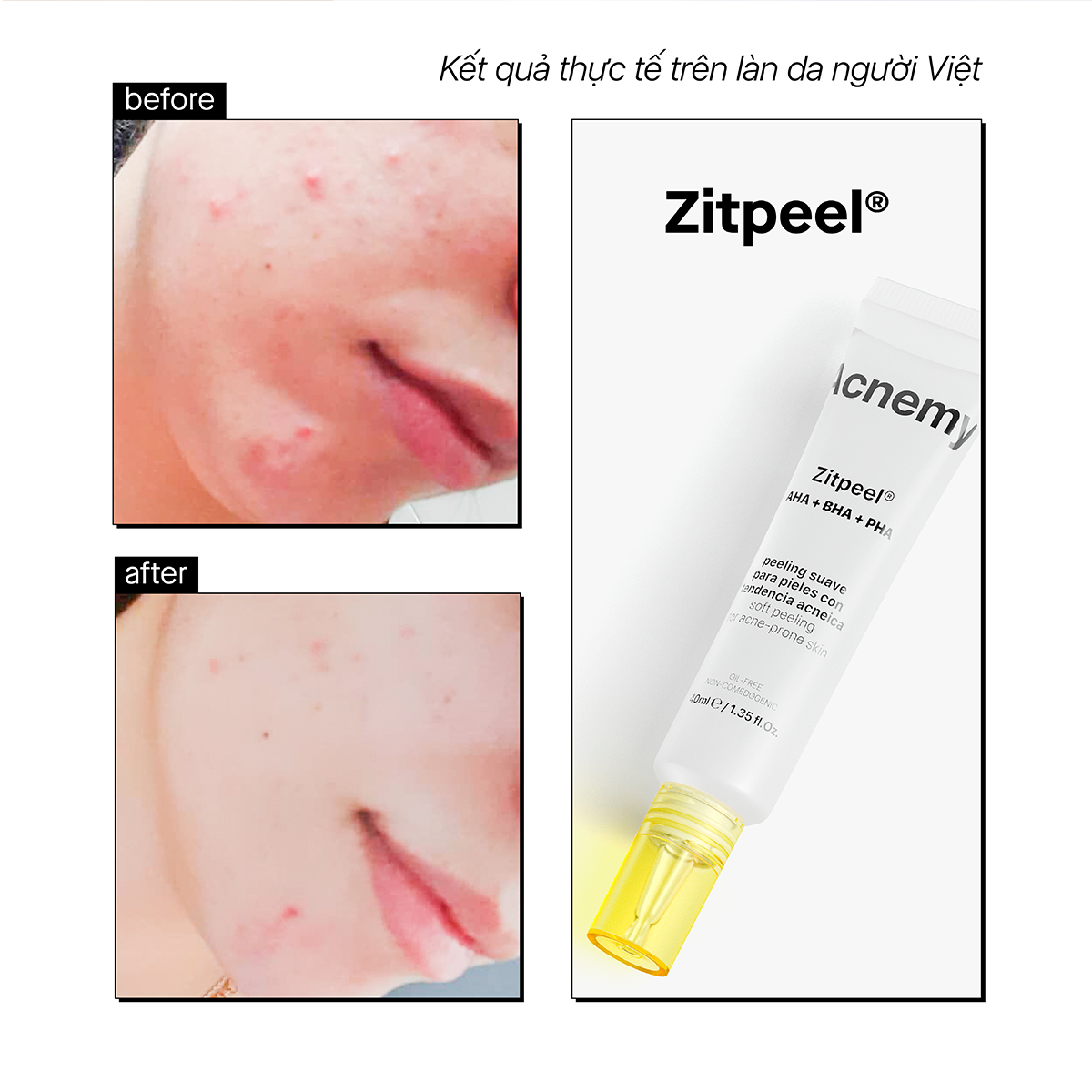 ZITPEEL® AHA+BHA+PHA - Ảnh 5